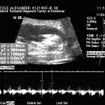 ultrasound at 12 week