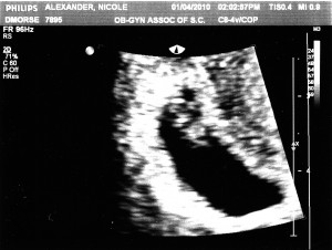 7 week ultrasound 1