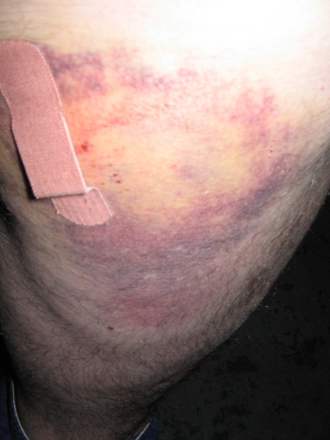 Right hip after 3 days. The color is spreading down my leg now.